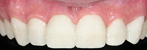 Palm Springs North Before and After Dental Implants