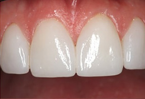 Palm Springs North Before and After Dental Implants
