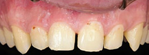 Miami Lakes Before and After Braces