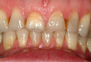 Miramar Before and After Teeth Whitening